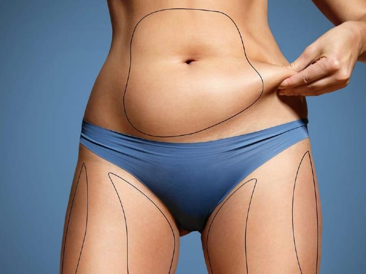 Coolsculpting vs. Liposuction