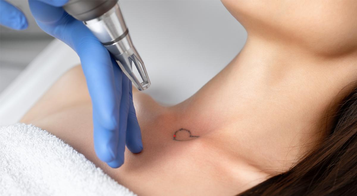 Tattoo Removal