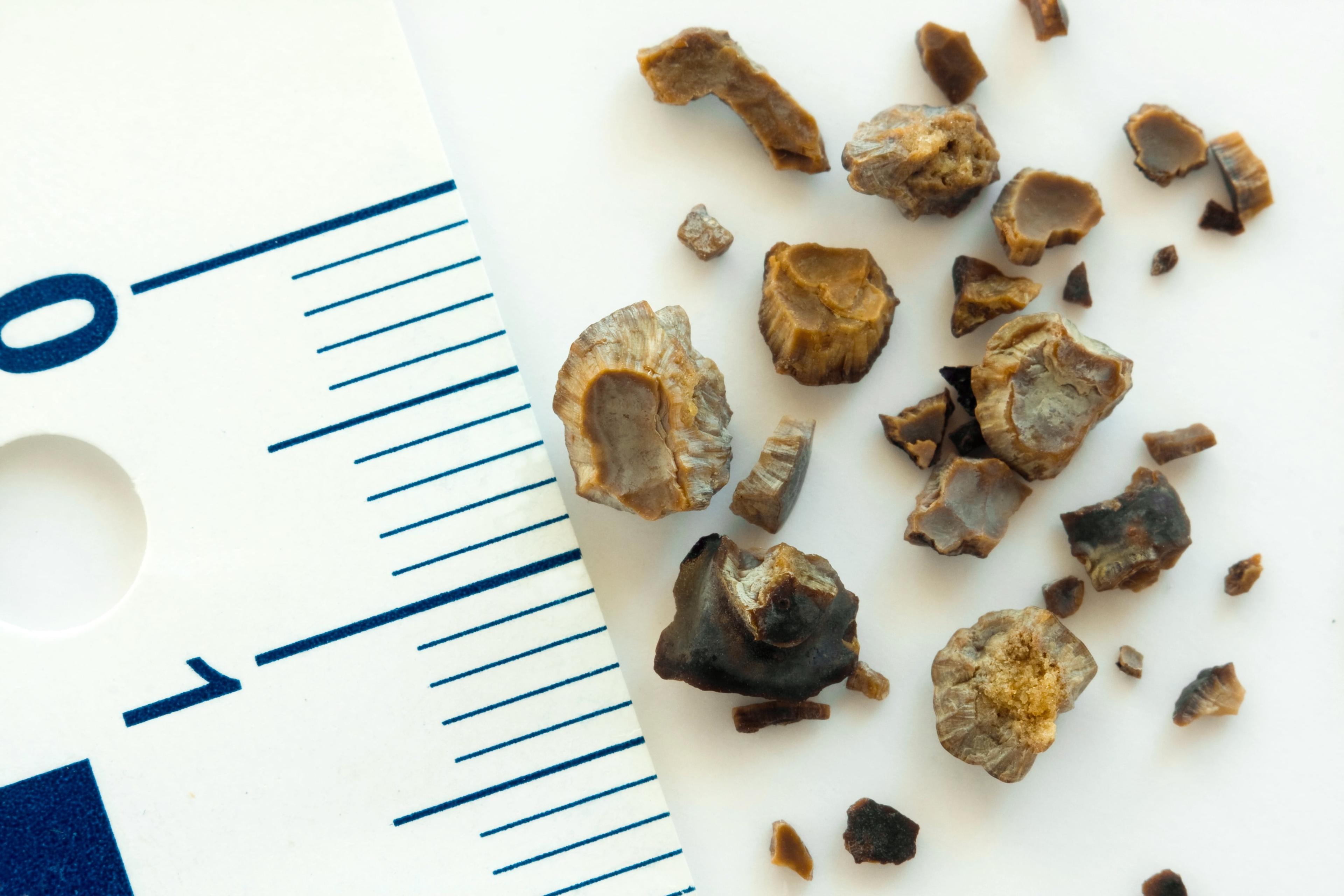 Kidney Stone Treatment