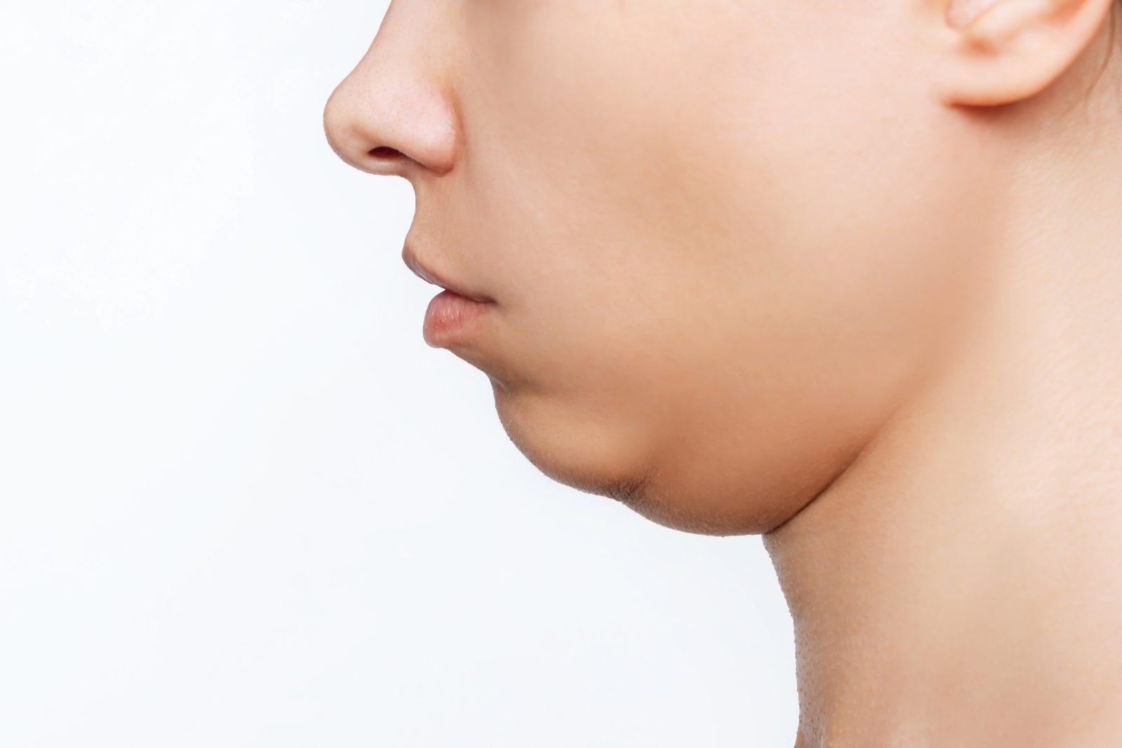 Chin Implant 