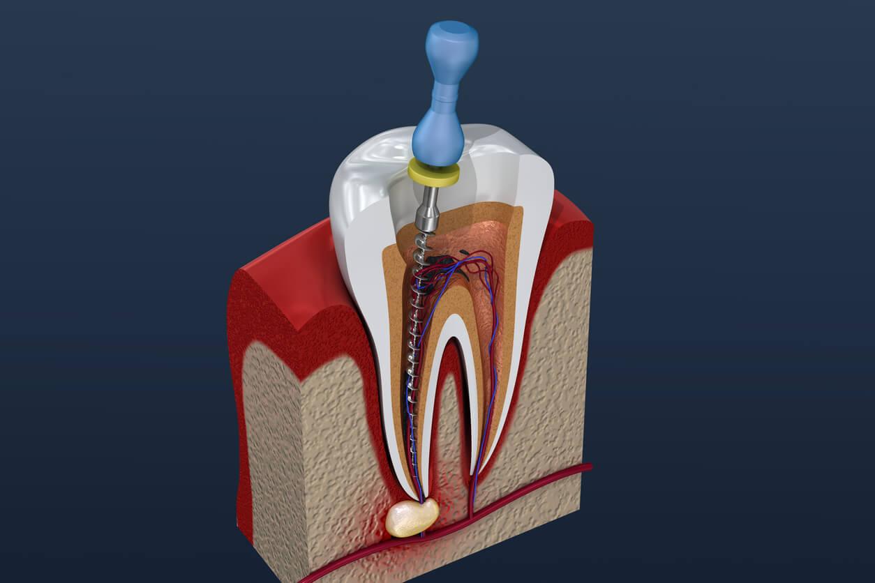 Endodontic Therapy (Root Canal/Apicoectomy)