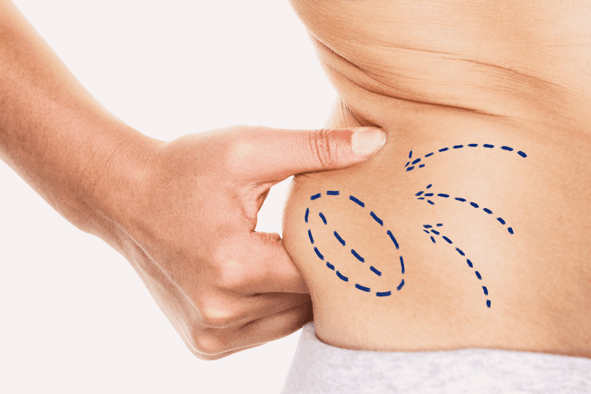 Tips on maintaining results after liposuction