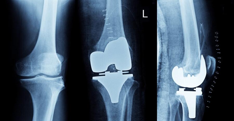 Mistakes after a Knee Replacement