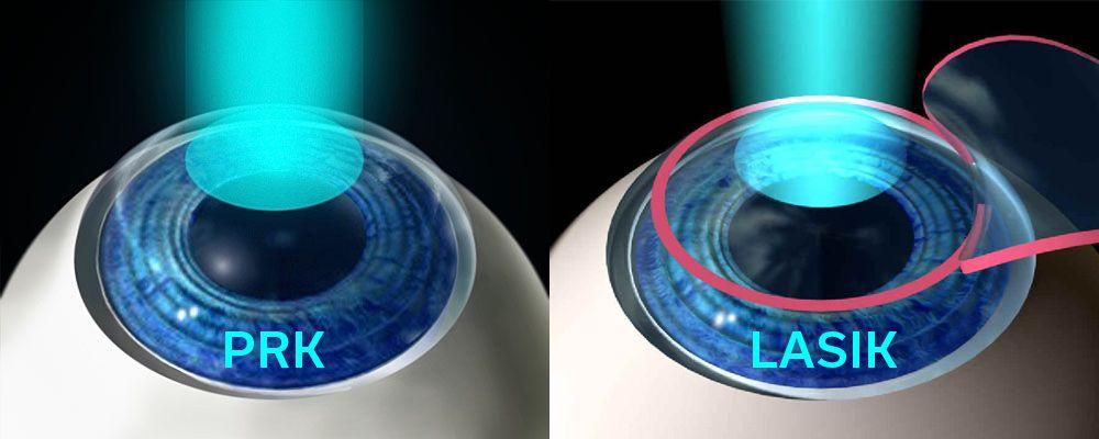 LASIK vs. PRK