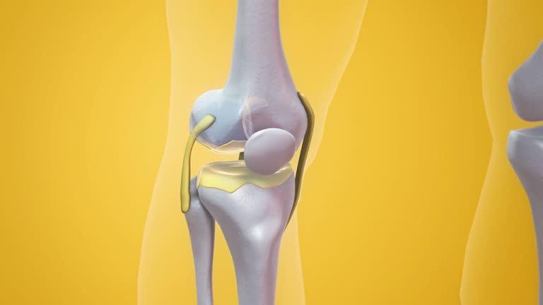 Joint Replacement