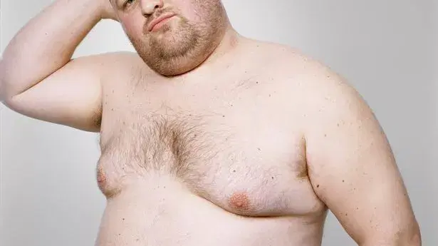 What is “gyno” (gynecomastia)?
