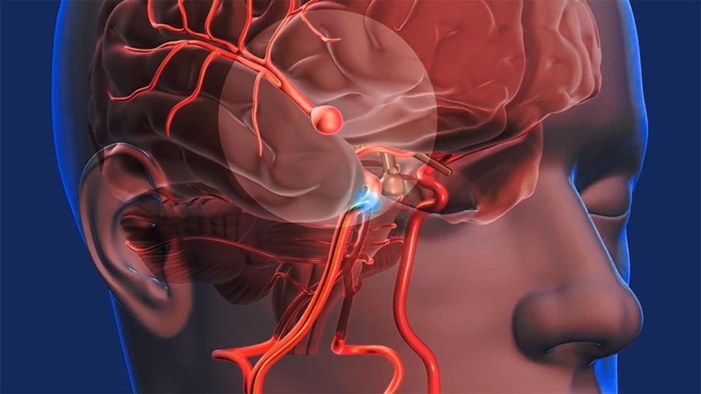 Cerebrovascular Surgery