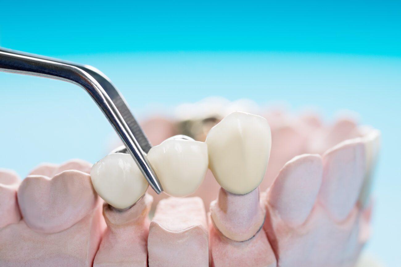 What is a dental crown?