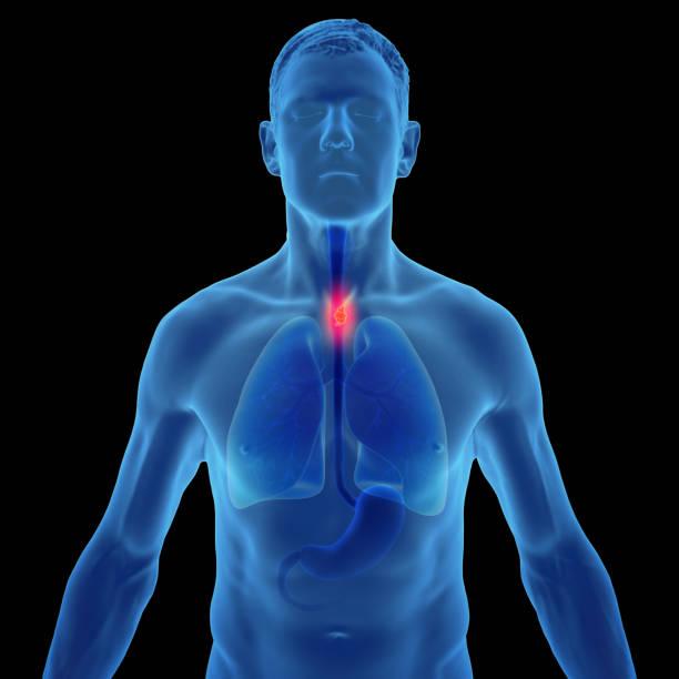 Esophagectomy cost in Iran