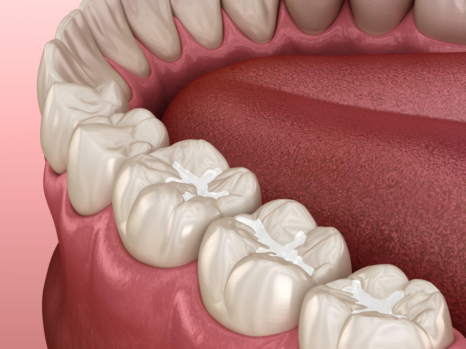 What is a dental composite?