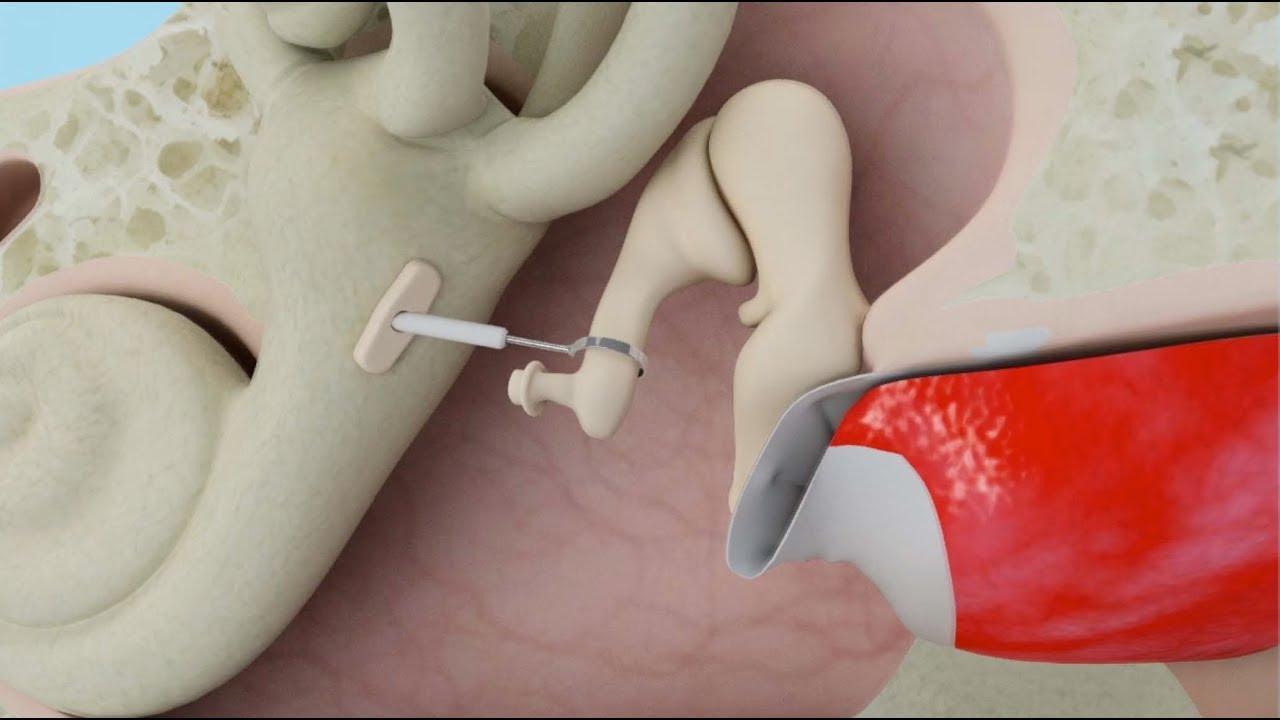What is stapedectomy surgery?