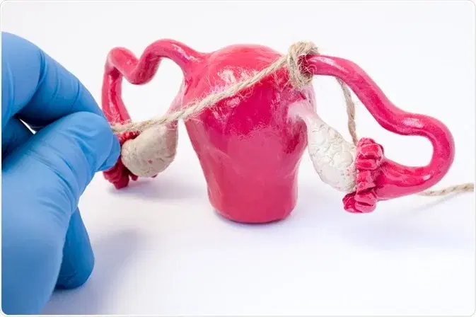 What are the benefits of female sterilization?