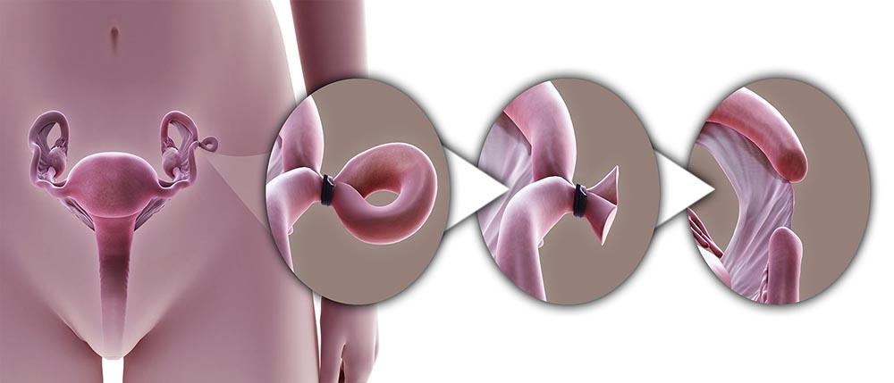 What are the disadvantages of female sterilization?