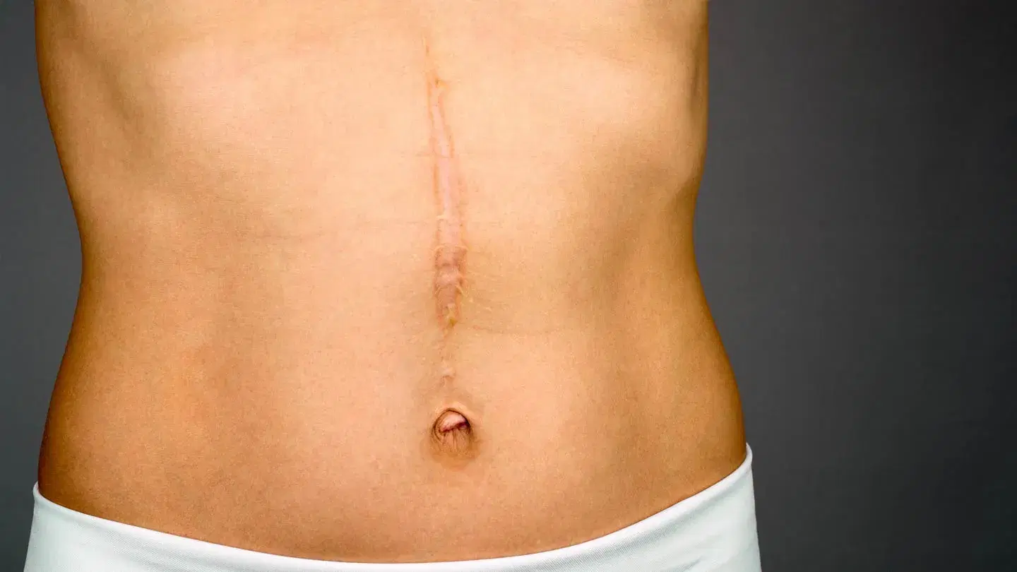 What Are the Best Options for Scar Removal?