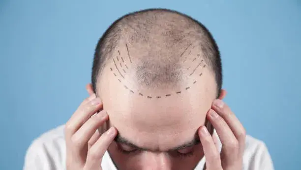 What are the side effects of Hair Transplant?