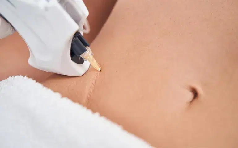 Laser Scar Removal: What you need to know