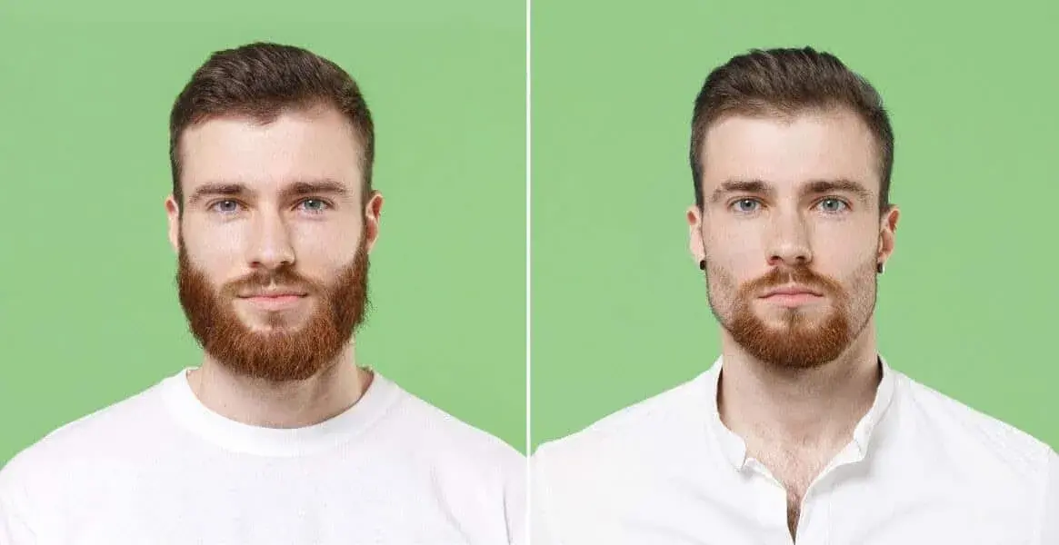 Beard Transplant candidates & aftercare