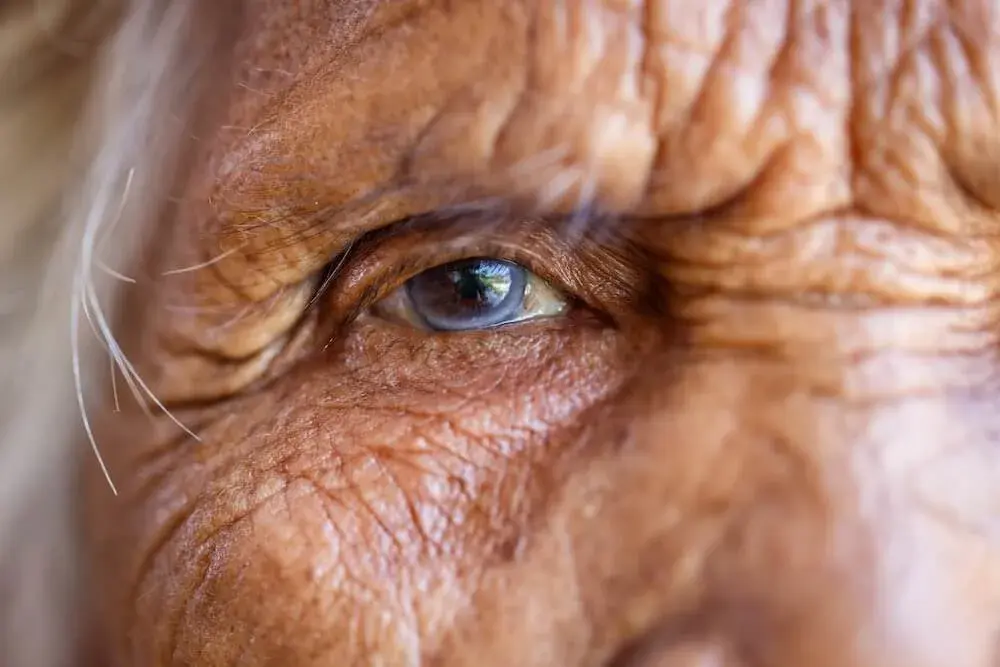 What are the signs of Cataract?