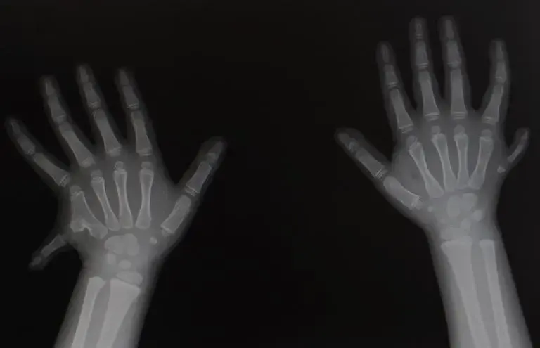 Why does Polydactyly occur & how is it treated?