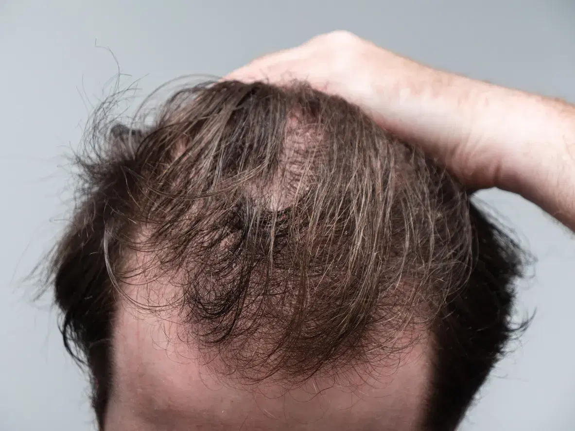 Are you a good candidate for Hair Transplant Surgery?