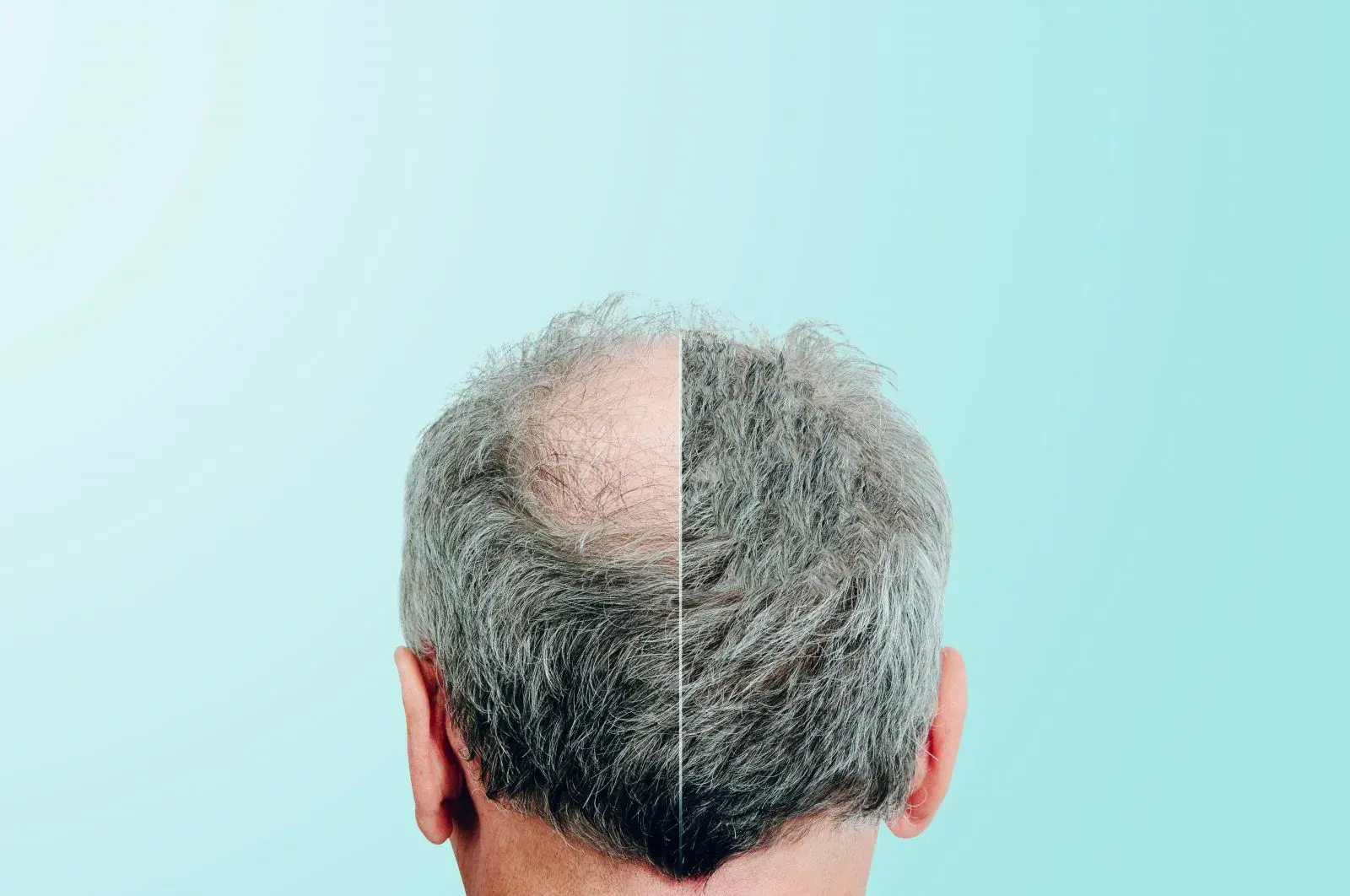 Hair Transplant