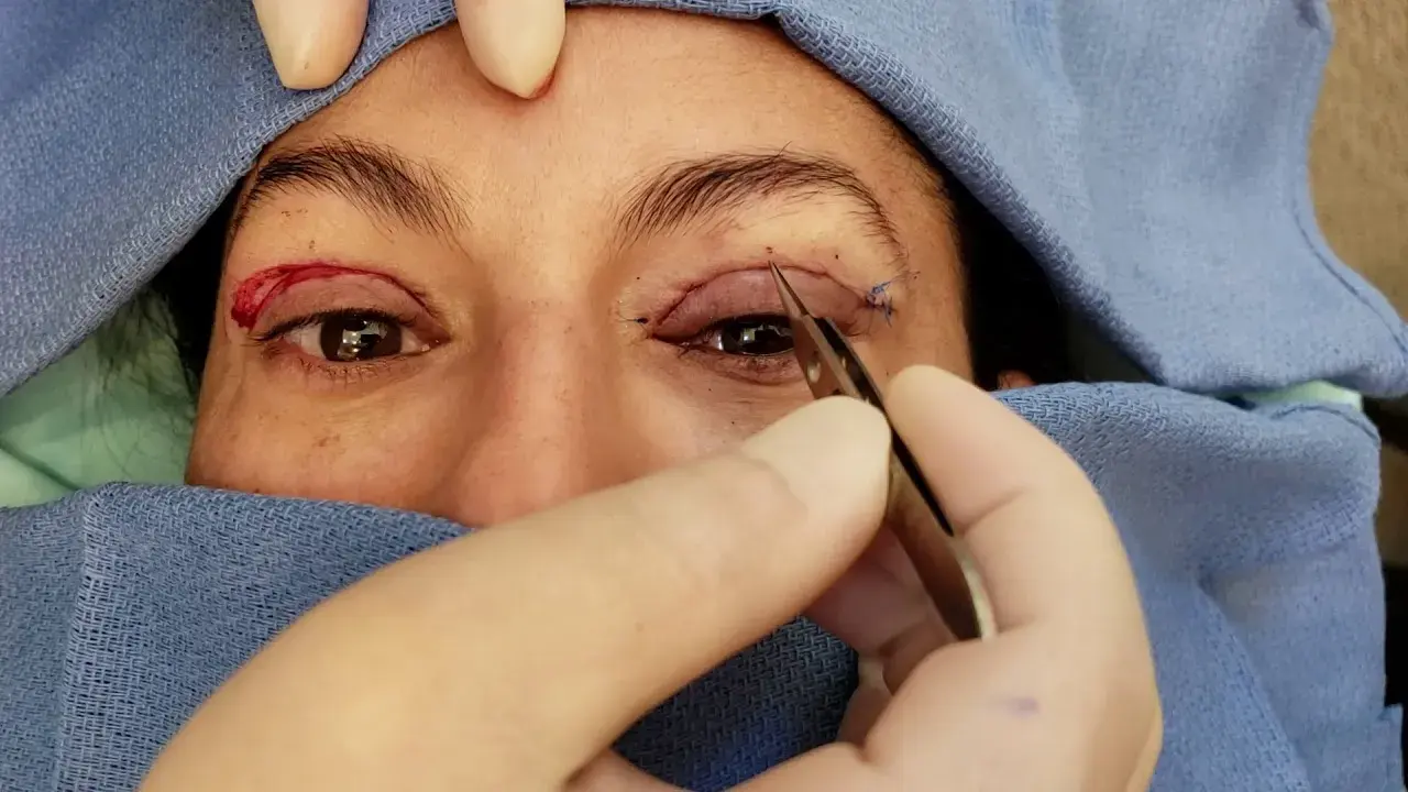 What is Upper Blepharoplasty Surgery?