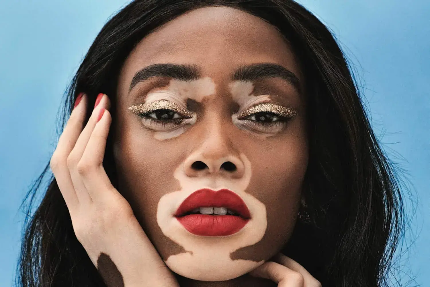 Which Celebrities have Vitiligo