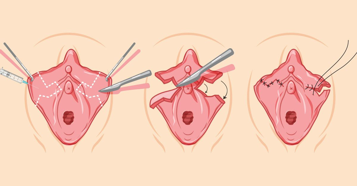 About Labiaplasty