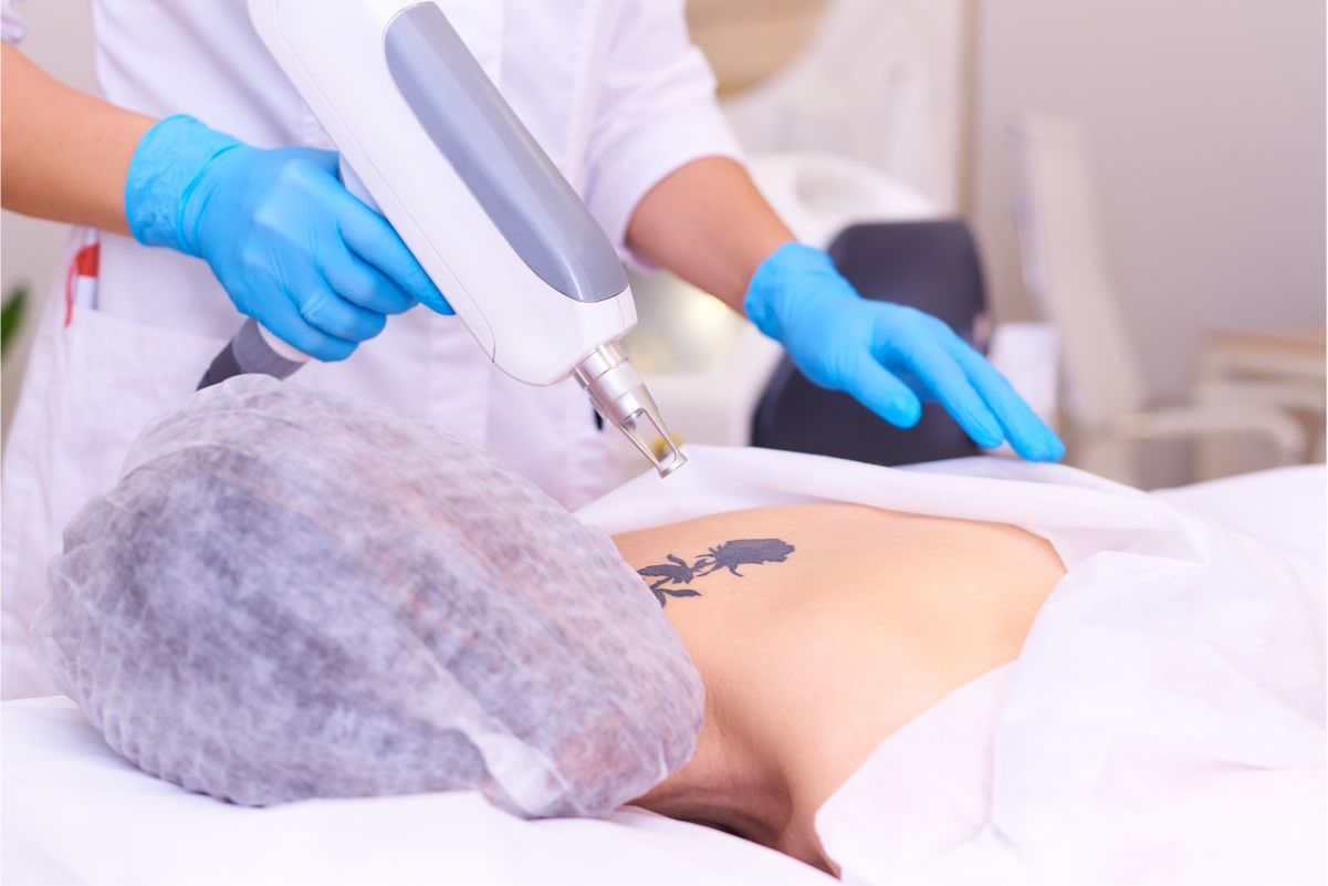 What Is Tattoo Removal? 