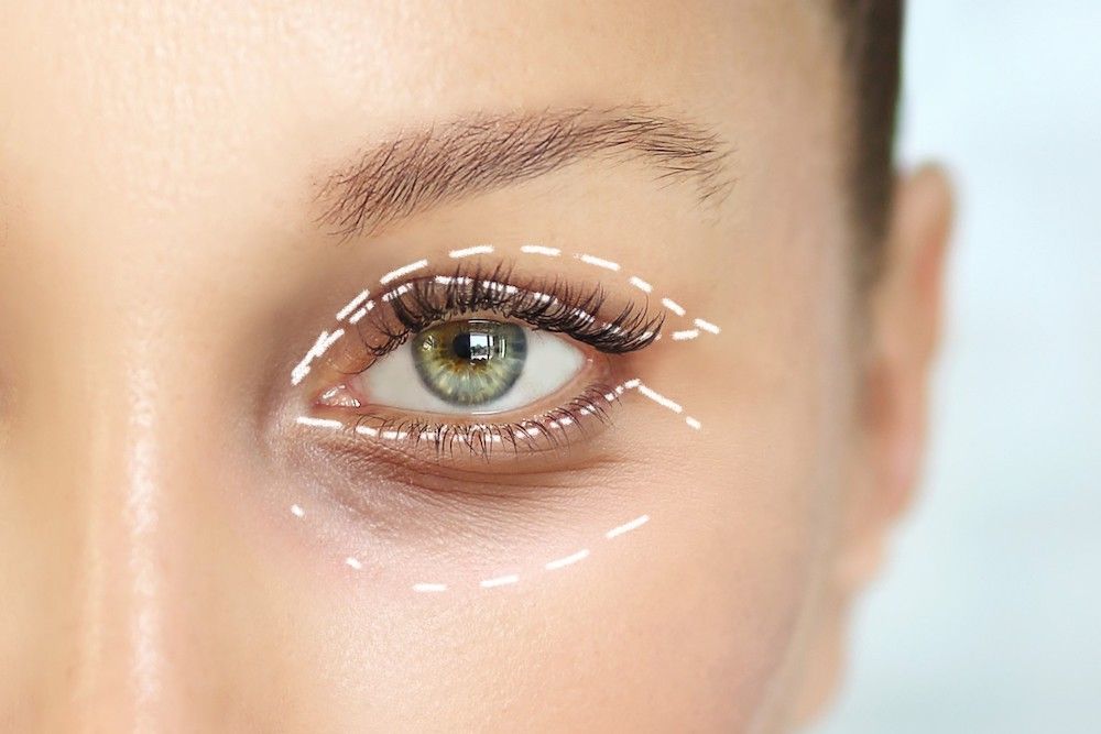 Blepharoplasty or Botox