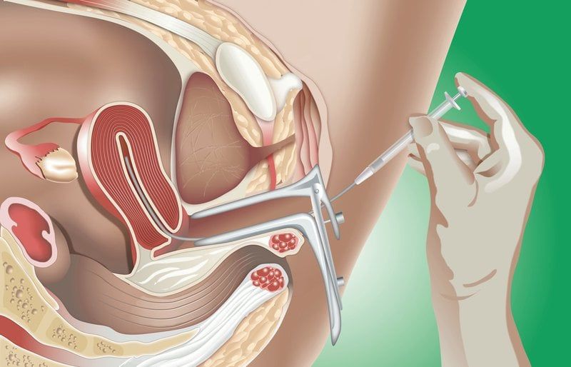 Intrauterine Insemination (IUI)