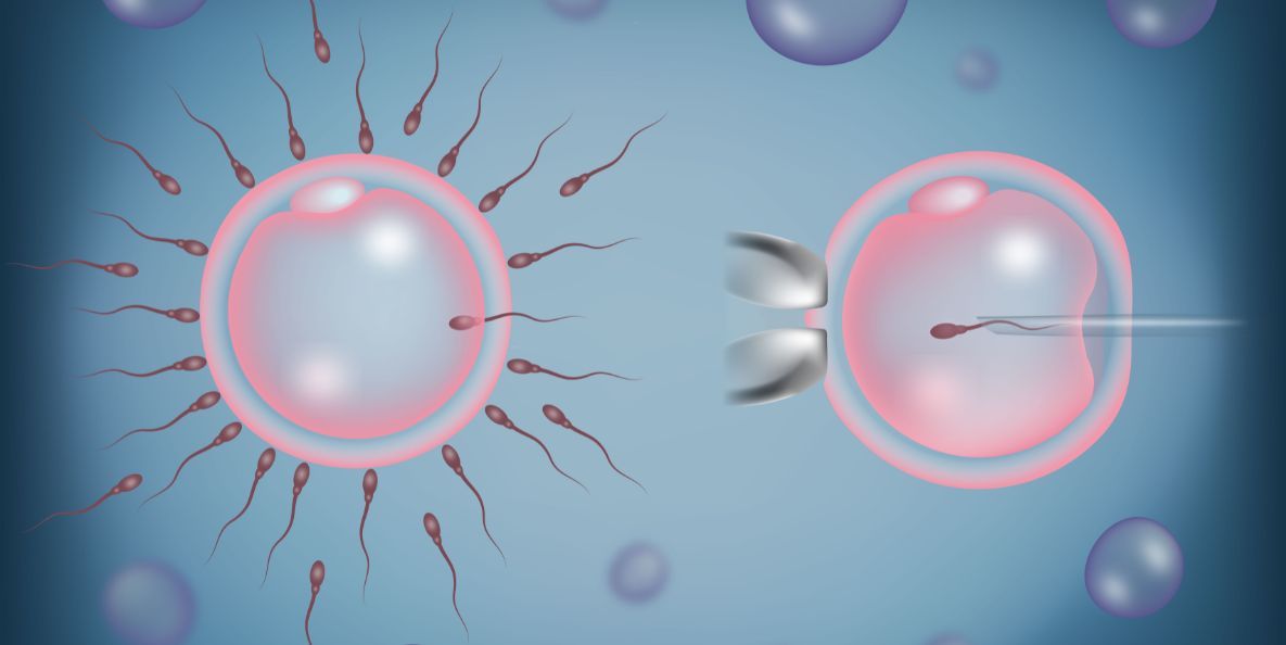 Intracytoplasmic Sperm Injection (ICSI) in Iran