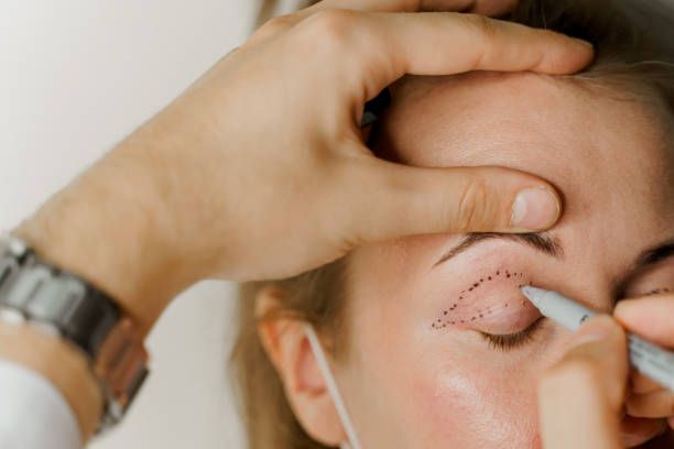 Blepharoplasty vs. Brow Lift