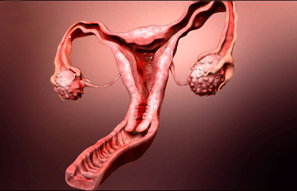 Female infertility conditions treated by surgery