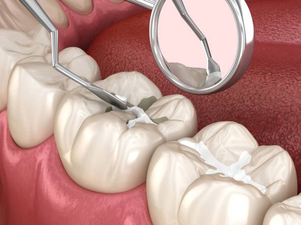 Different Types of Dental Filling Materials