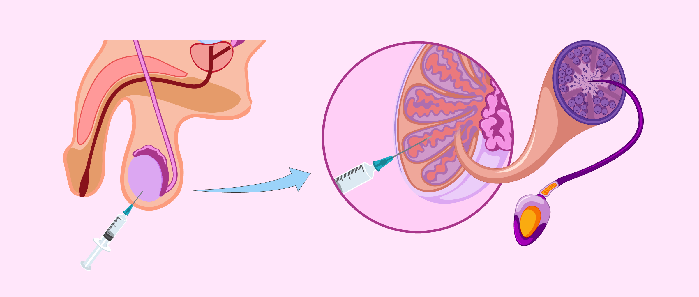 What is micro-TESE? 