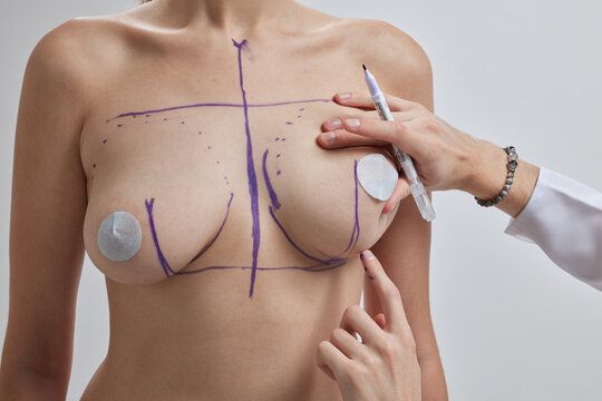 Mammaplasty vs. Mastectomy