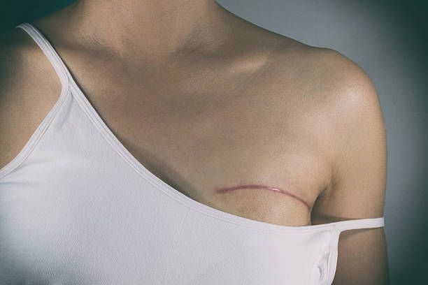 Mammaplasty vs. Mastectomy