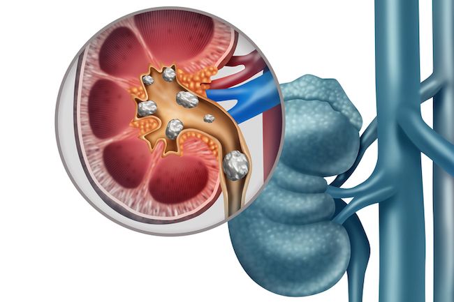 Kidney Stone Treatment in Iran