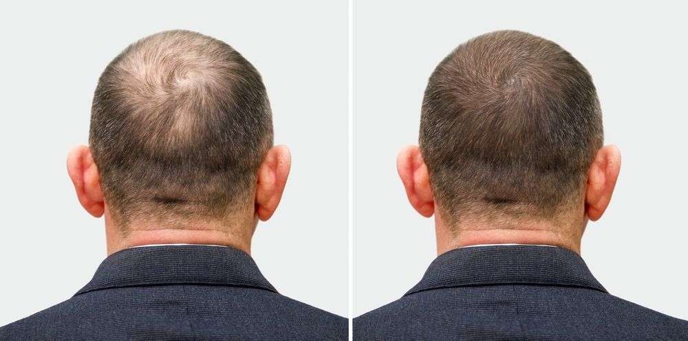 Hair Transplant vs. PRP Therapy