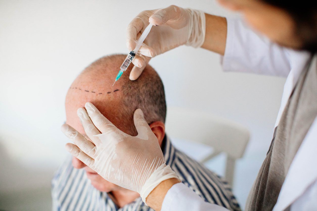 Hair Transplant vs. PRP Therapy