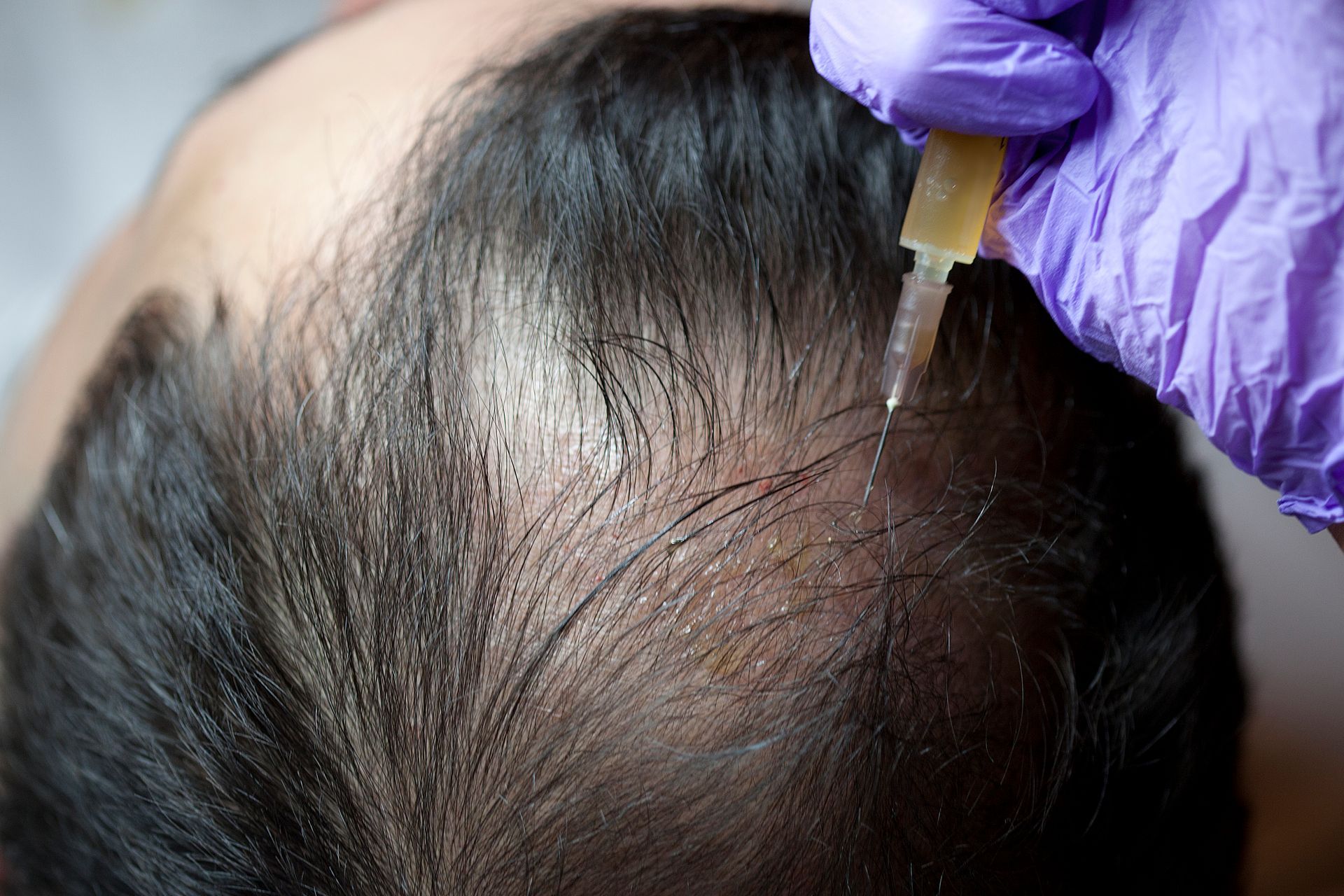 Hair Transplant vs. PRP Therapy