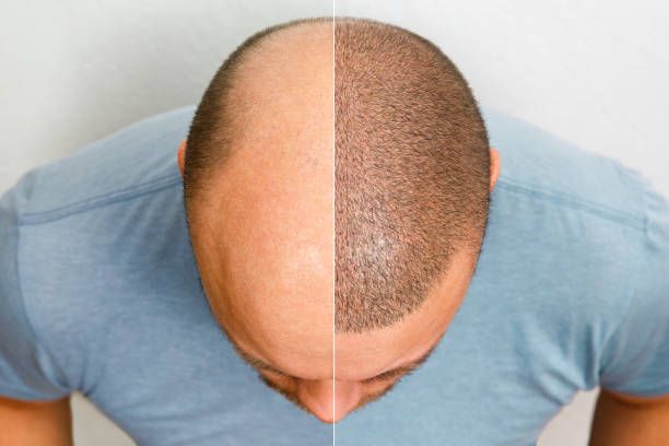 Hair Transplant vs. PRP Therapy