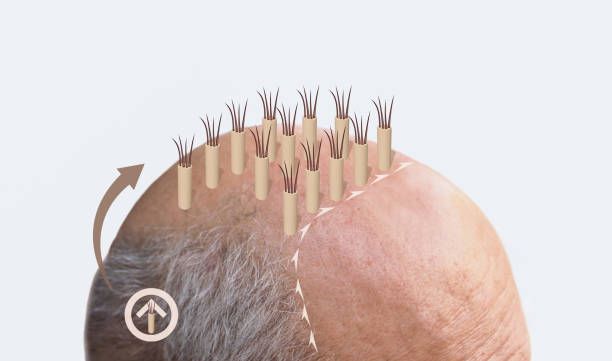 DHI vs. FUE Hair Transplant