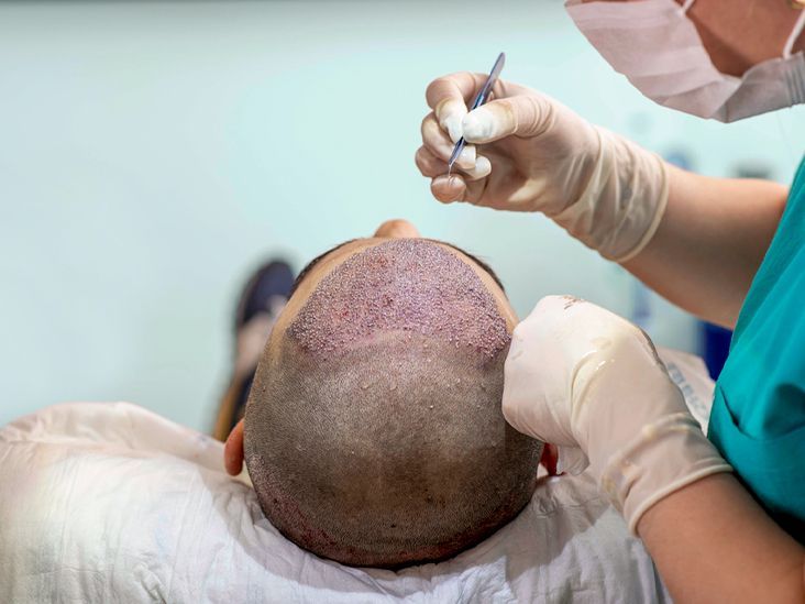 DHI vs. FUE Hair Transplant