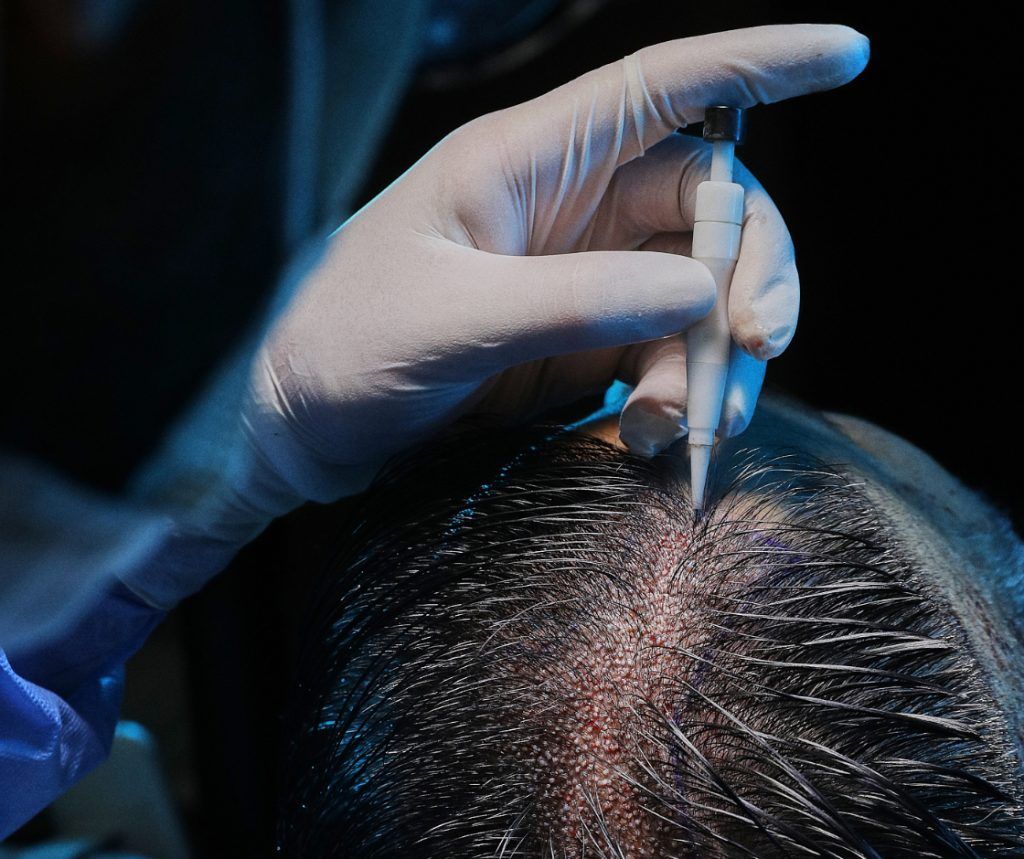 DHI vs. FUE Hair Transplant