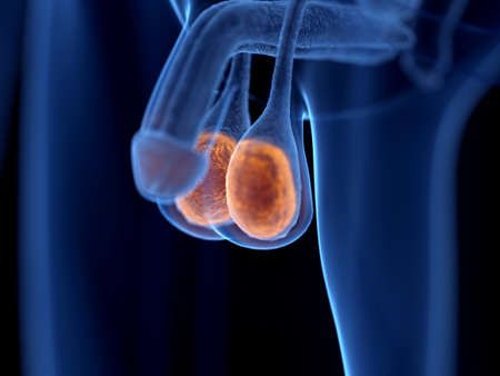 Testicular Cancer Treatment in Iran