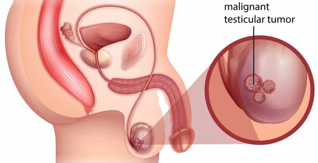 Testicular Cancer Treatment in Iran