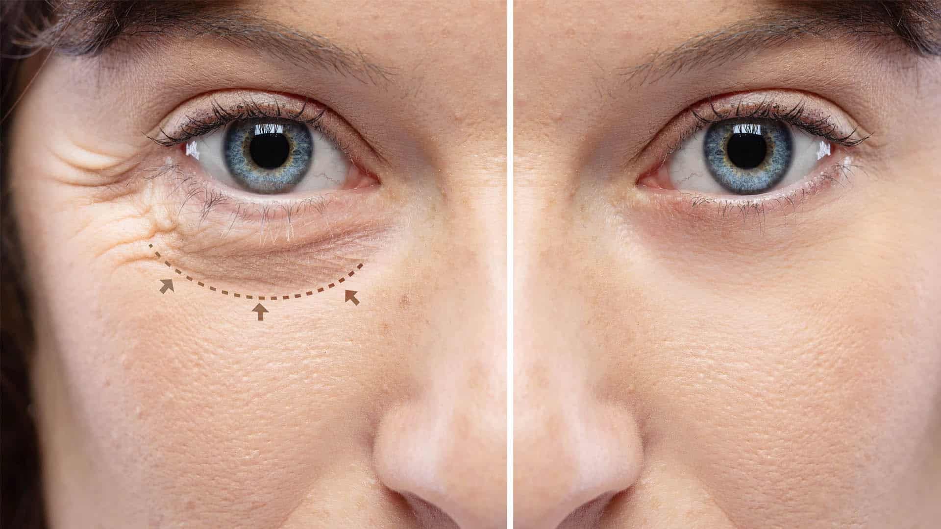 Filler vs. Blepharoplasty