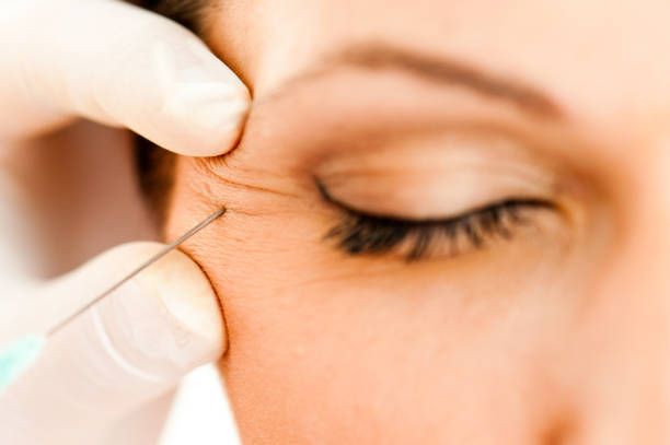 Filler vs. Blepharoplasty